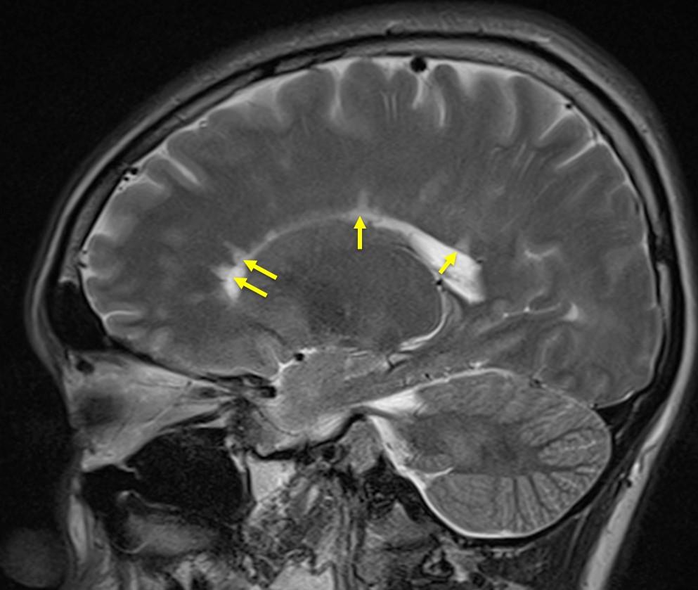 Dawson fingers (multiple sclerosis) – Radiology Cases