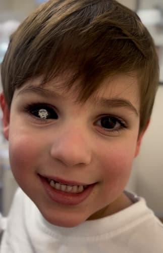 Custom Ocular Prosthetics