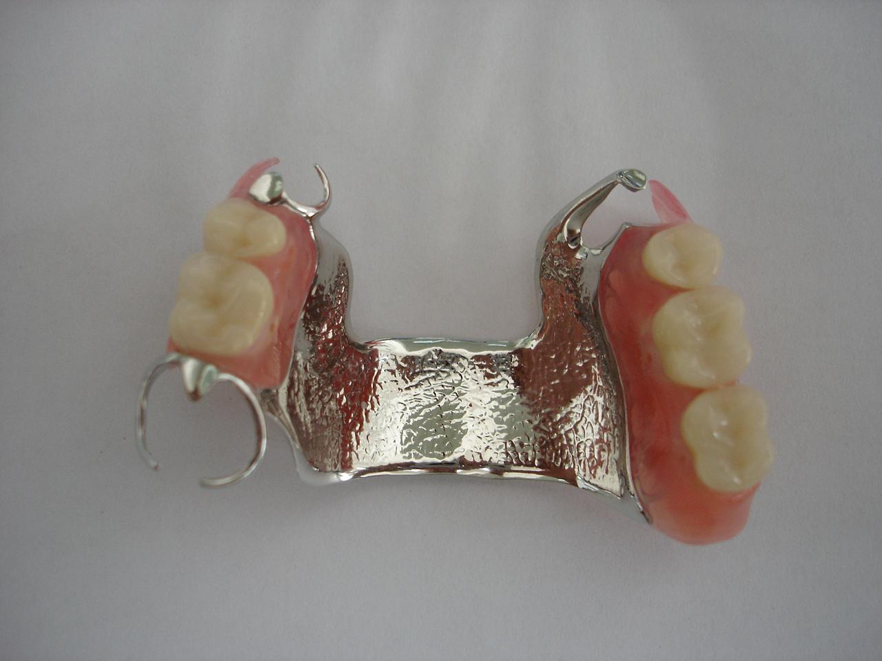 Vitallium 2000 cast metal partial | Partial denture | Removable ...