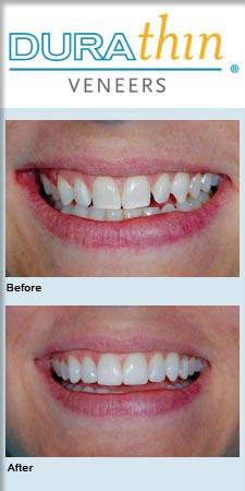 Butler, AL Dentist | Leanne McDonald, DMD, MAGD | Durathin® Porcelain ...