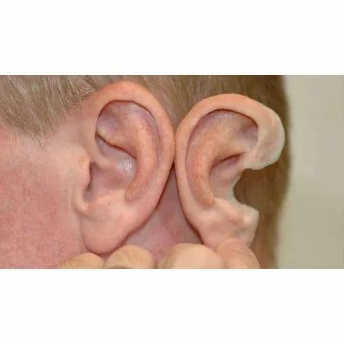 Artificial Silicon Ear at ₹ 5000 | Silicone Ear Prosthesis in New Delhi ...