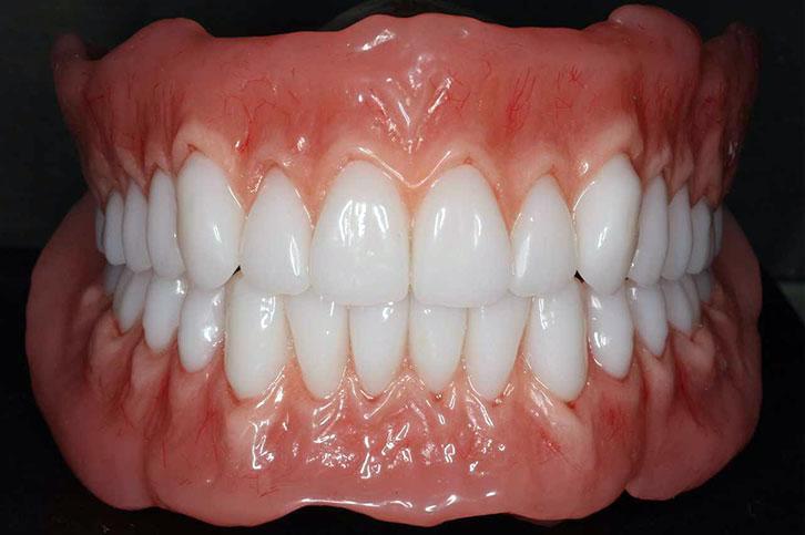 Biofunctional Prosthetic System Dentures | Alux Dental