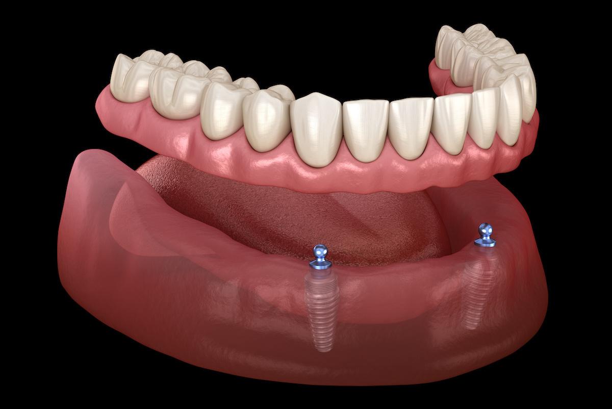 Implant Overdentures