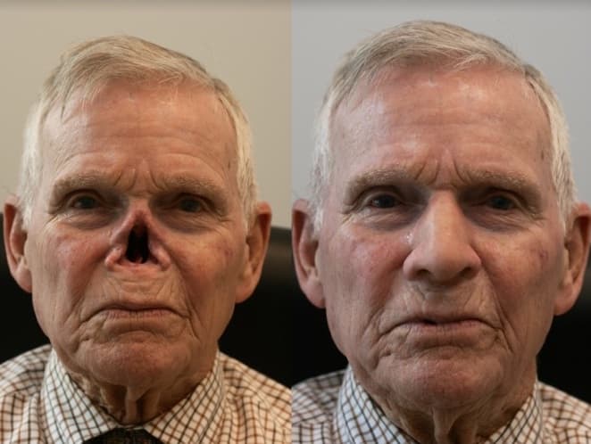 Top 5 Prosthetic Noses in Canada 2026 - Natural Fit