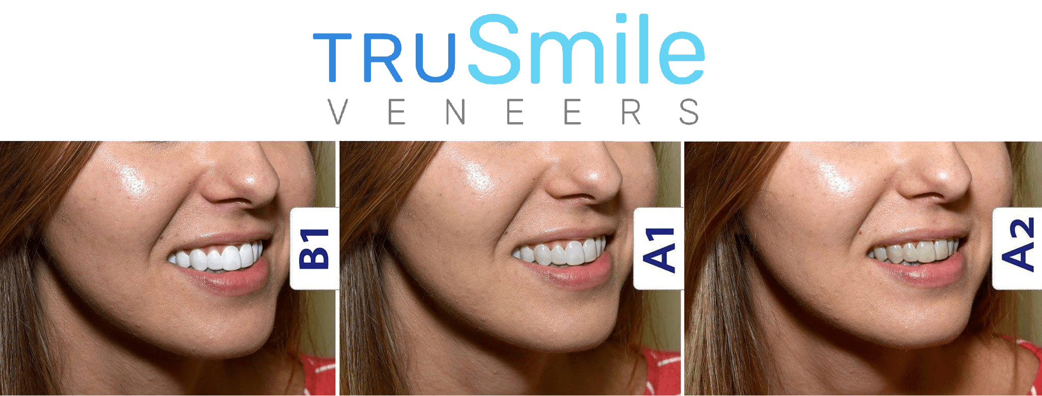 TruSmile Custom Made Veneers – TruSmile Veneers in 2020 | Veneers ...