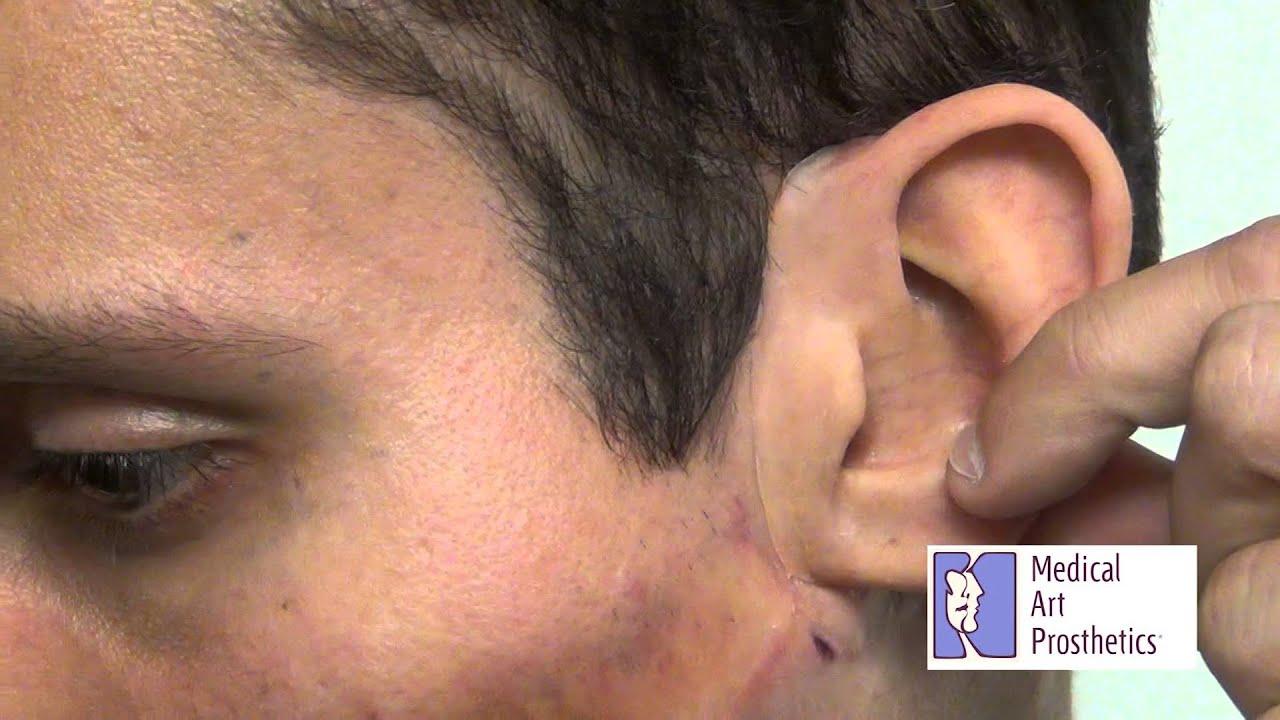 Medical Art Prosthetics Ear 60 - YouTube