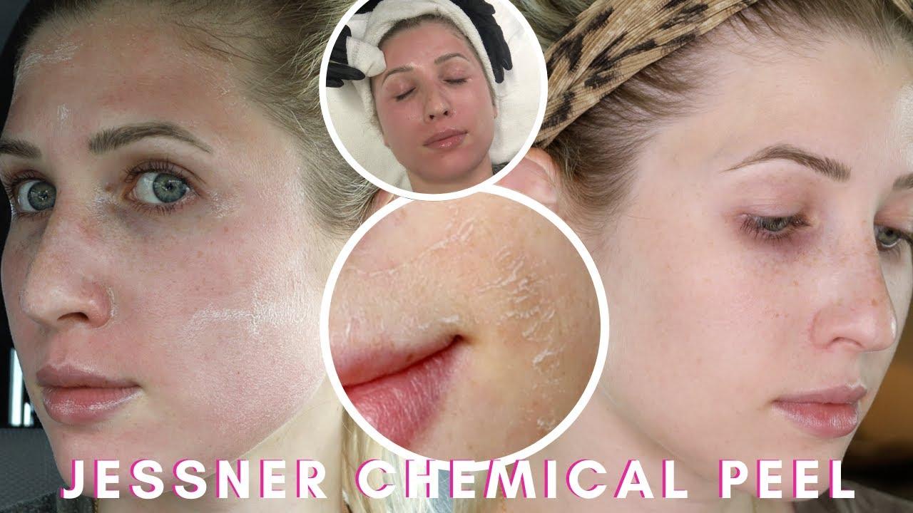 My CHEMICAL PEEL Experience // JESSNER Chemical PEEL - YouTube