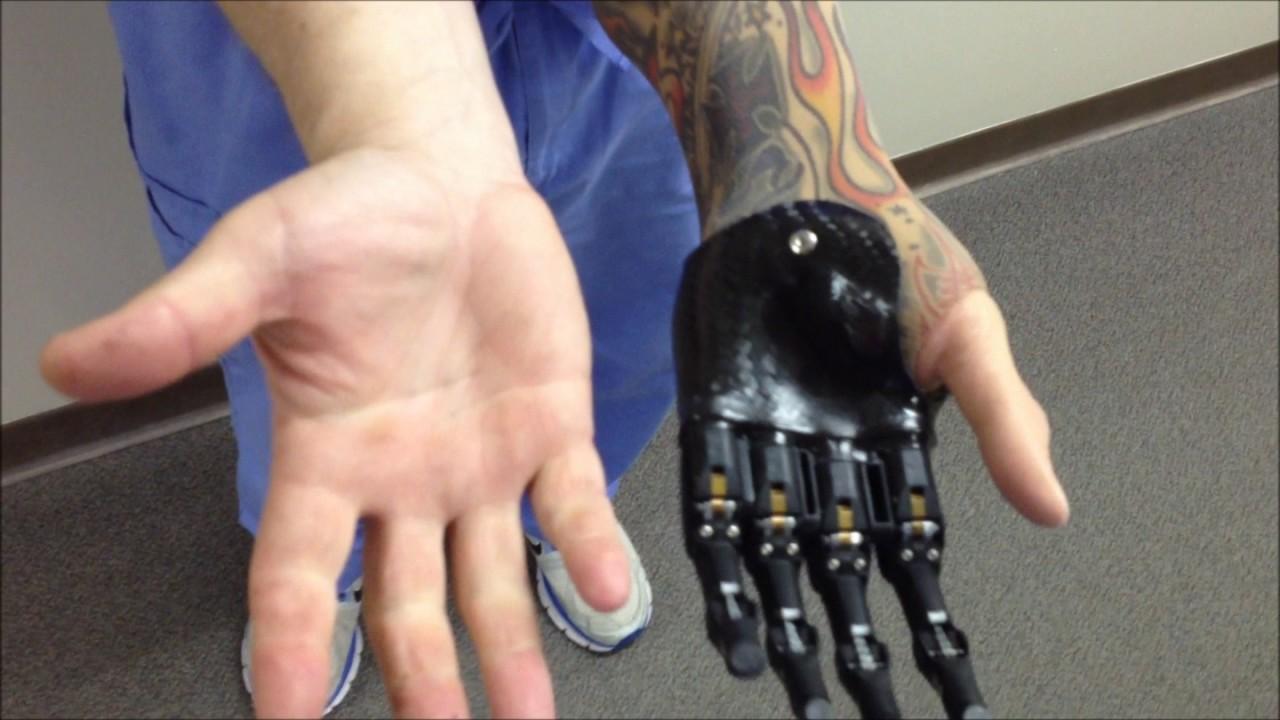 I-digits from Touch Bionics - YouTube