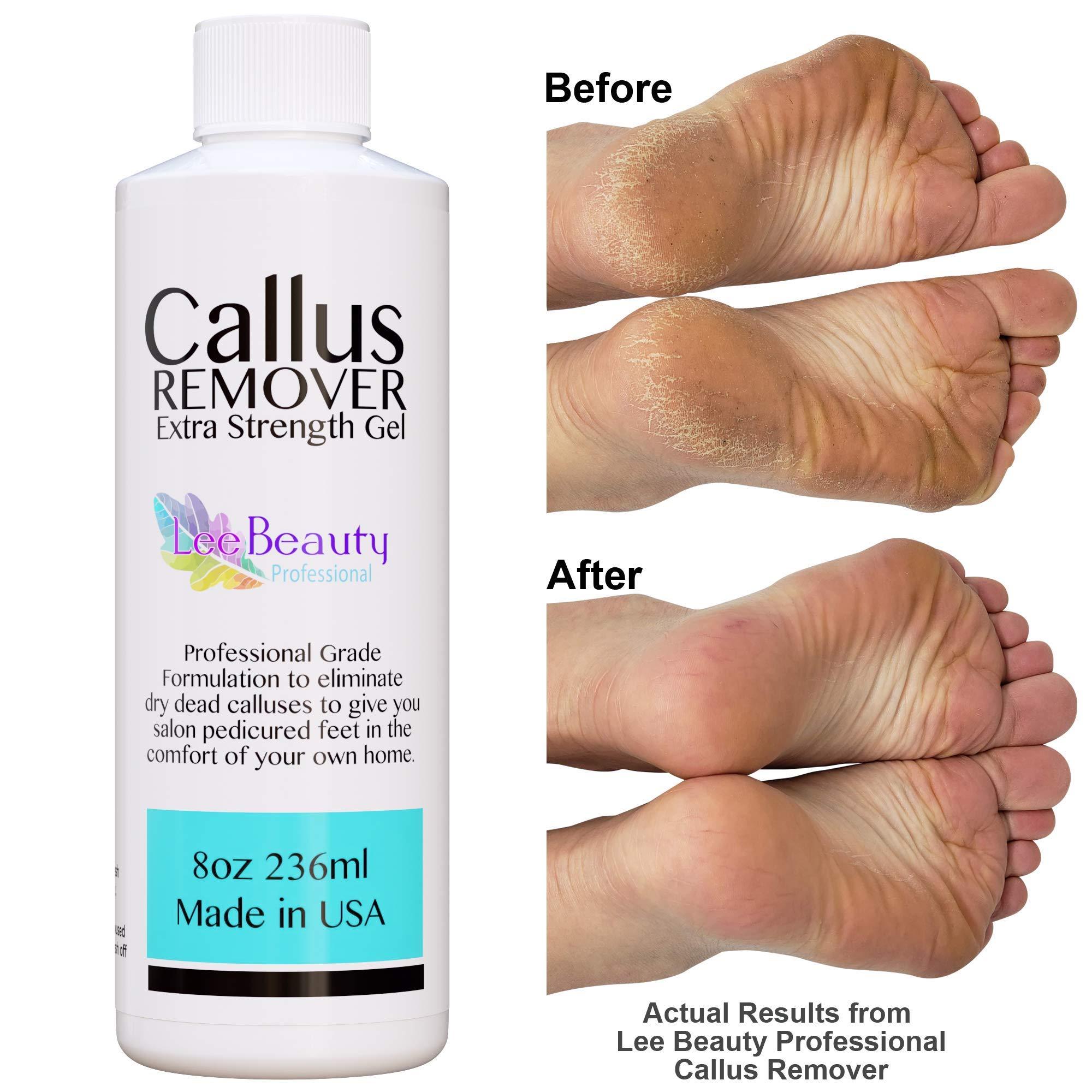 8oz Callus Remover gel for feet for a professional pedicure. Better ...