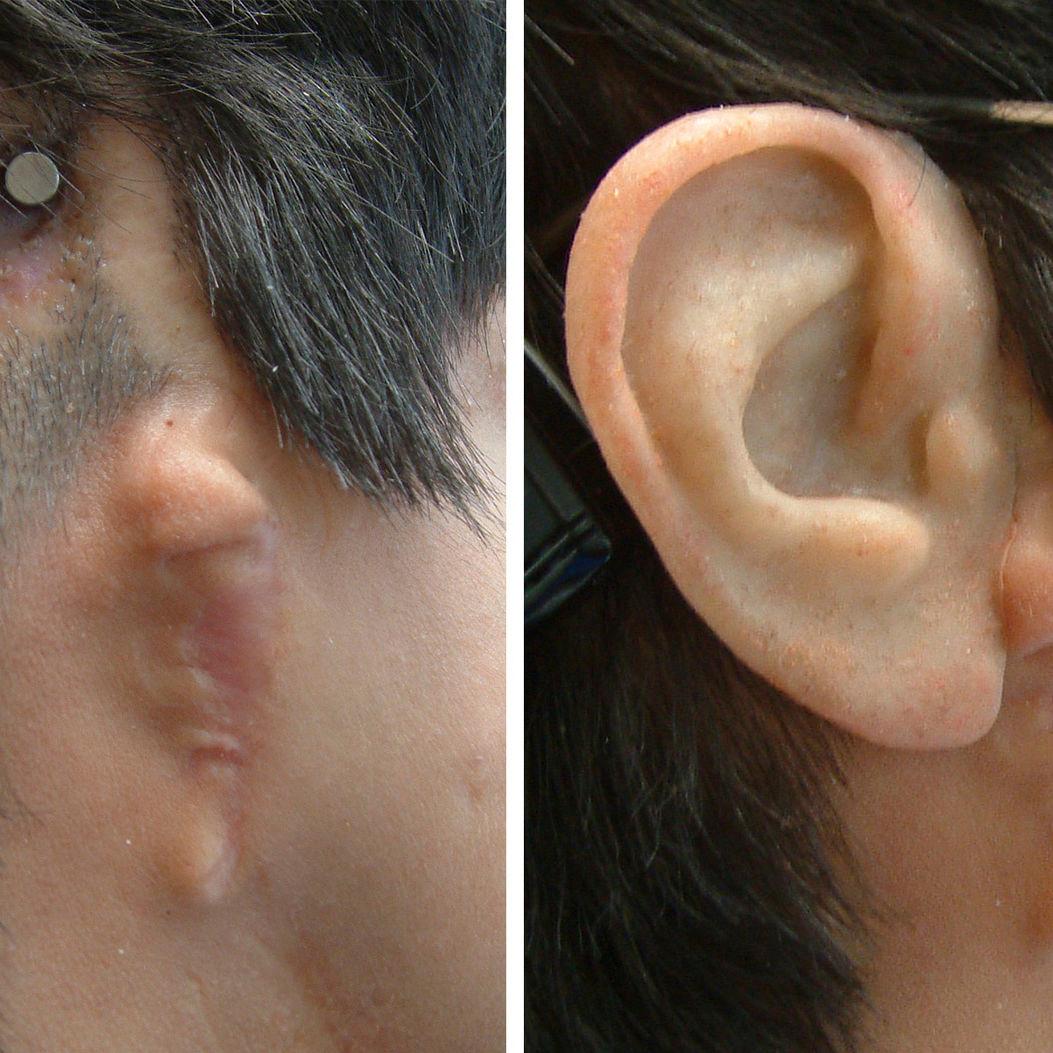 Auricular cosmetic prosthesis - Prosthetic Artists - adult