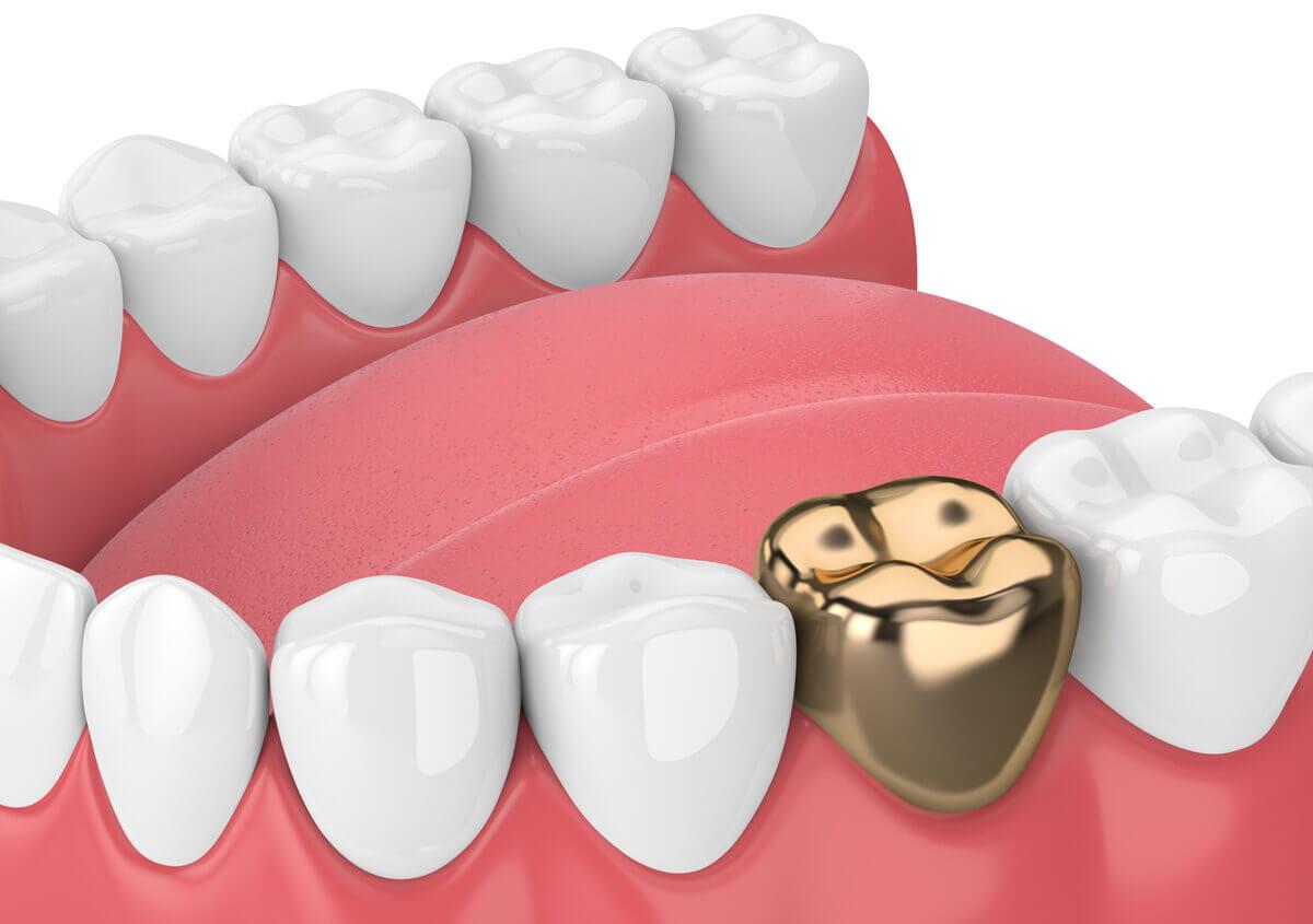 Gold Dental Crown - Cost, Facts, Pro & Cons | Ladys Island SC Dentist