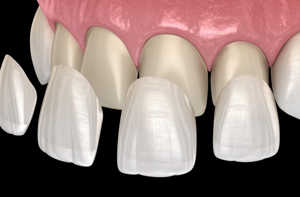 Are Dental Veneers Permanent? Dental Veneer FAQs