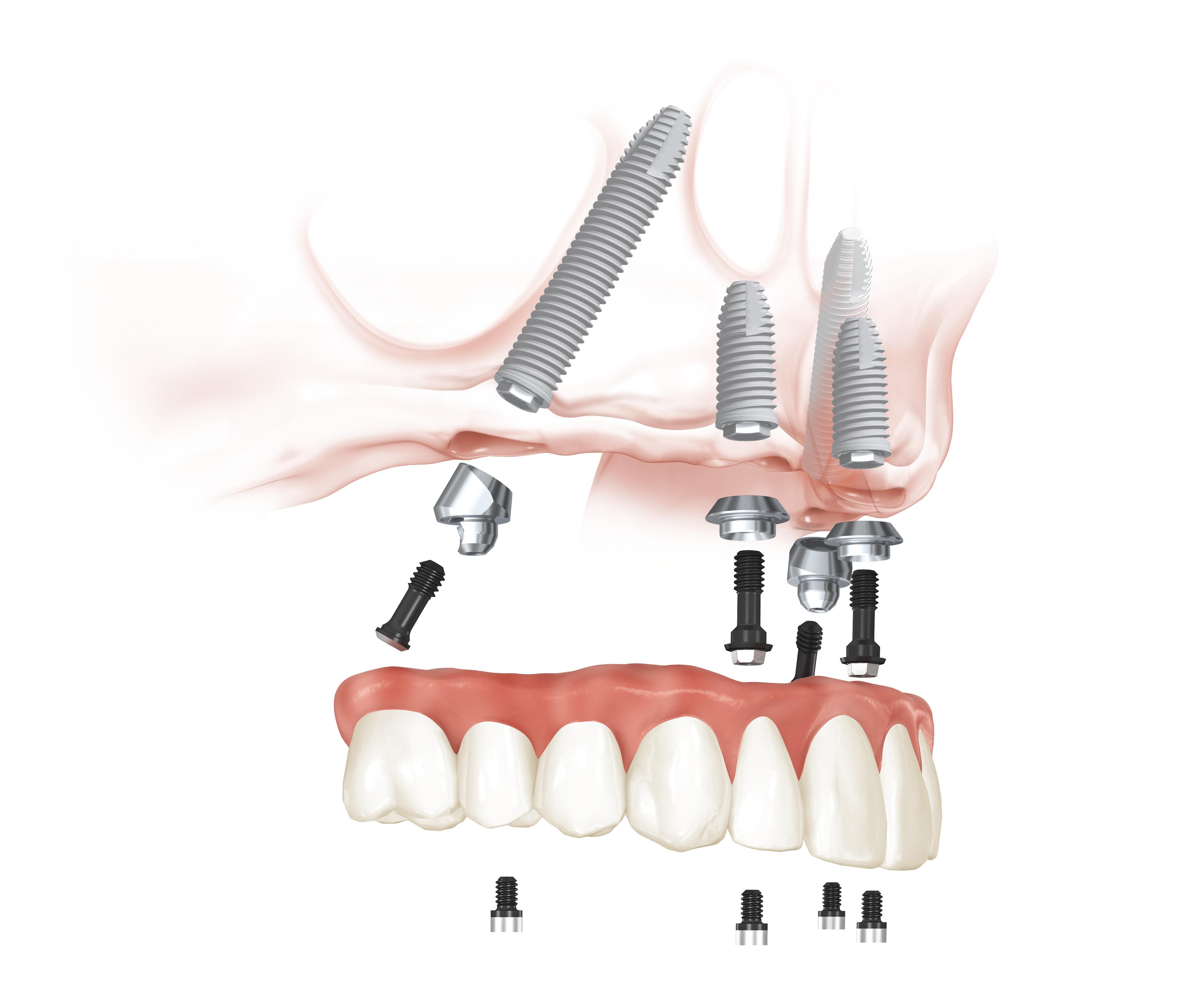 Nobel Biocare introduces the All-on-4® Treatment Concept | Aegis Dental ...