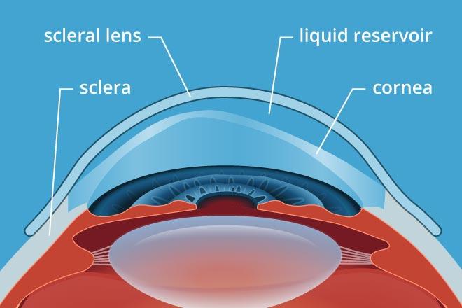 Scleral Contact Lenses - Busby Eye Care