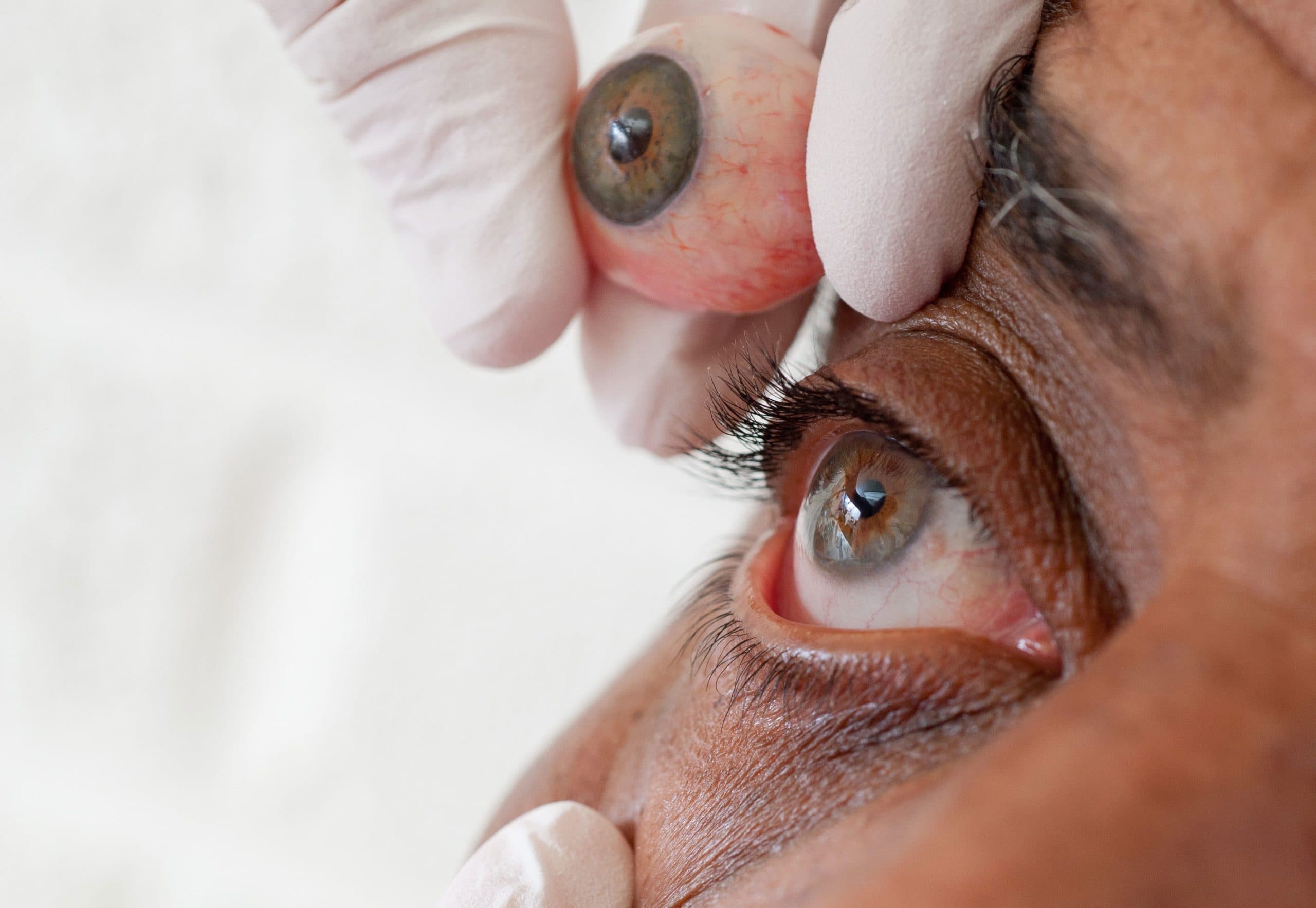 The Art of Iris Matching in Custom Prosthetic Eyes