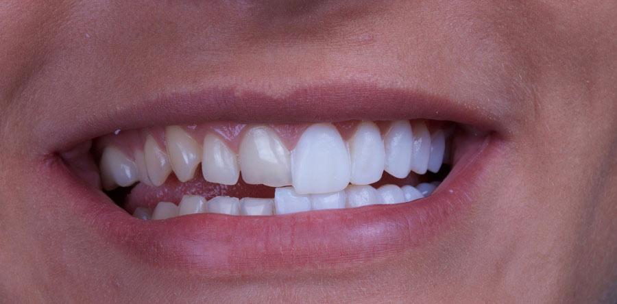 Porcelain Veneers | Cosmetic Dentistry | Dentist Belfast | Cranmore Dental