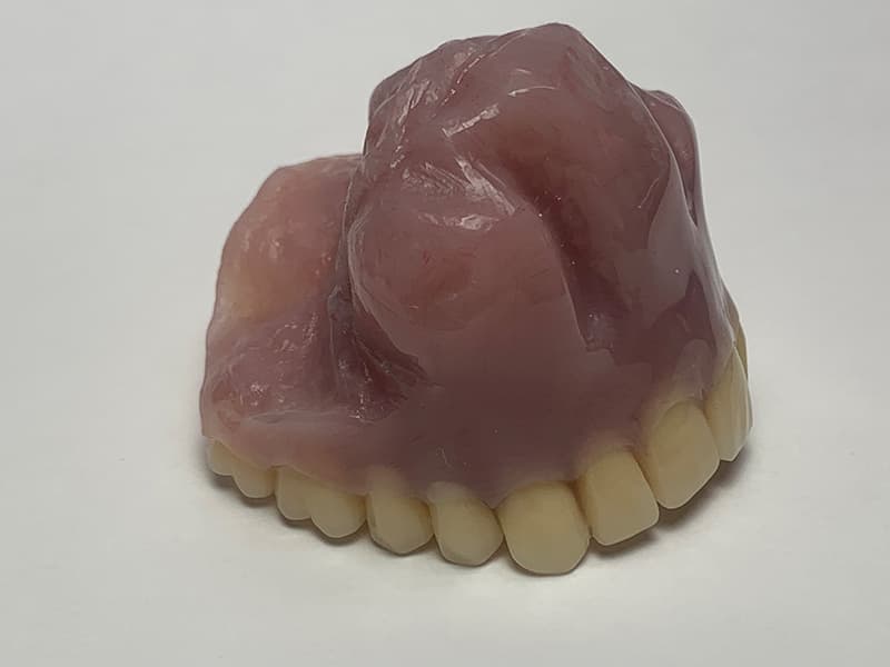 Palatal Obturators by Global Dental Solutions