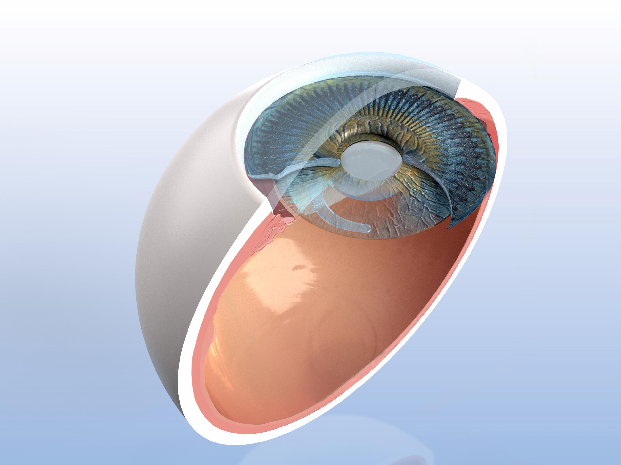 The ARTIFICIALIRIS for your patients with aniridia | HumanOptics