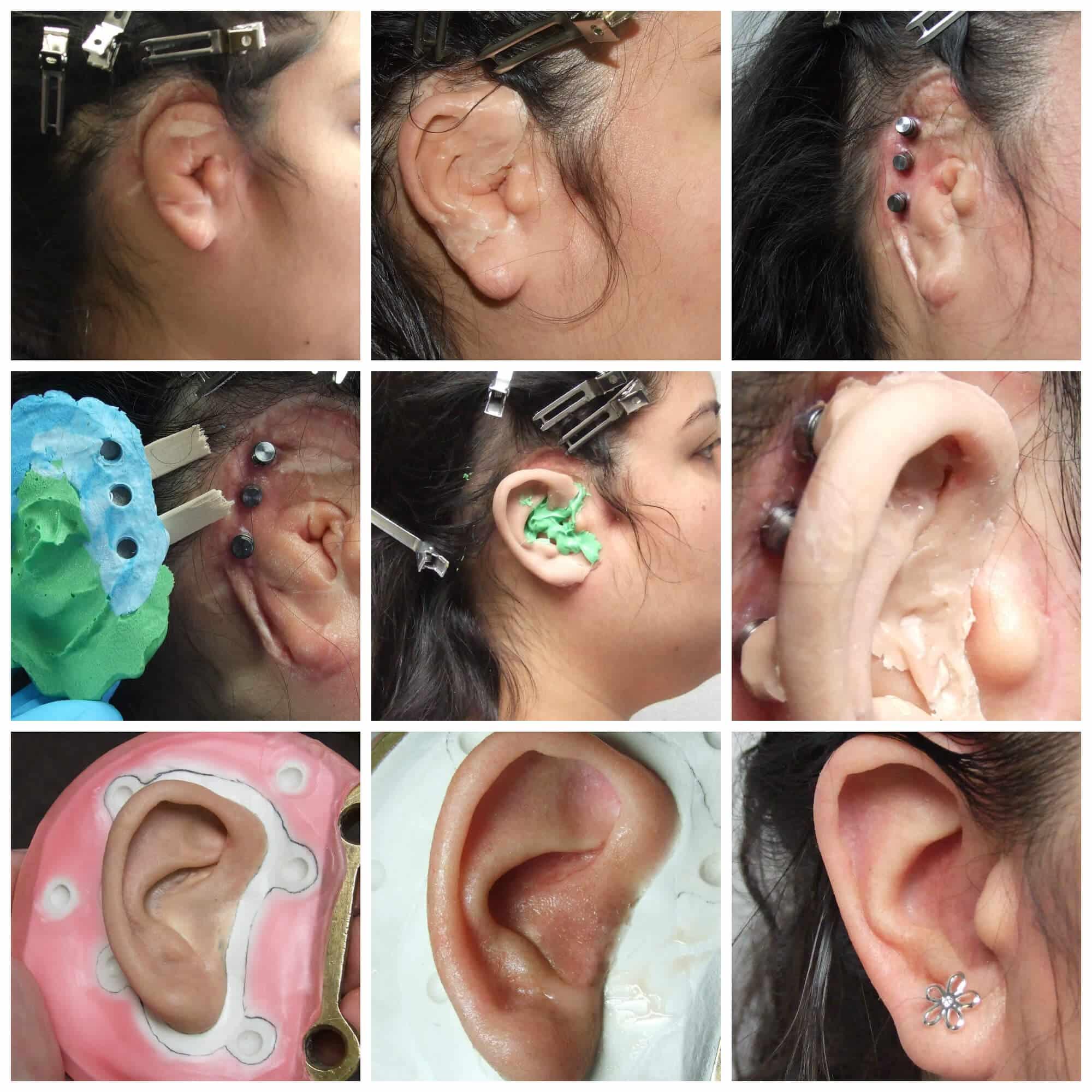 Microtia Ear Prosthetics | Feel More Confident & Comfortable