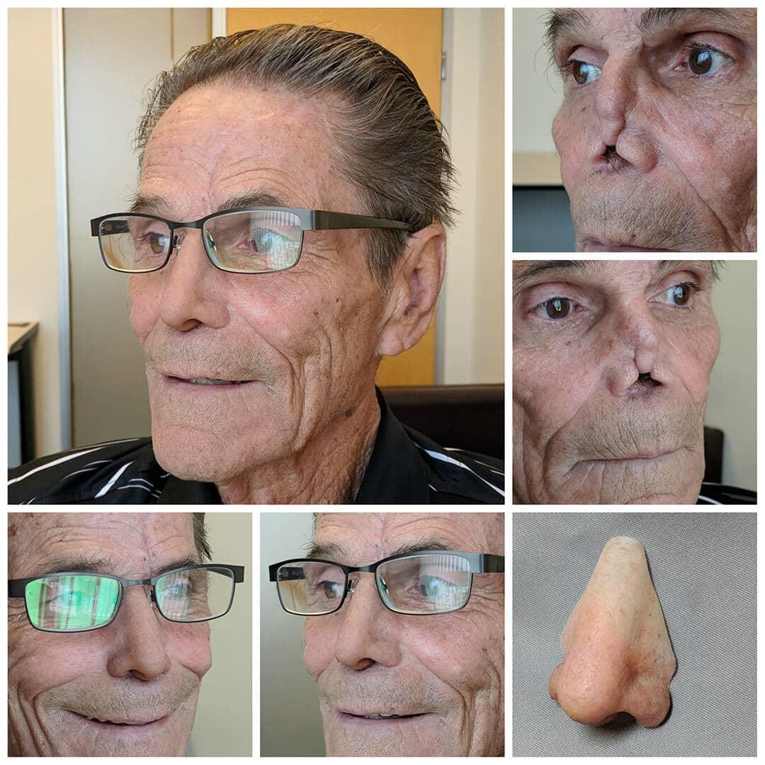 Nasal Photo Gallery – Medical Art Prosthetics