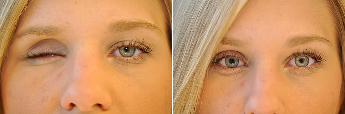 Patient of ocular prosthetics before and after photos.