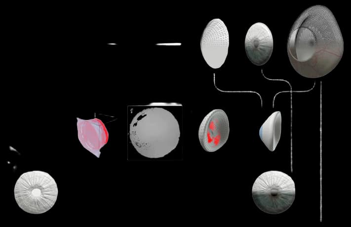 Pediatric Right Ocular Prosthesis - Erickson Laboratories