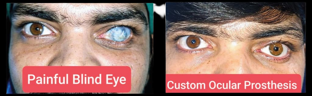 Prosthetic Artists Inc - Custom Facial & Ocular Prosthetics