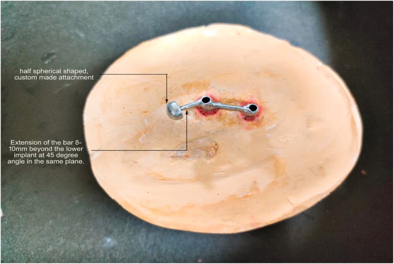 Half sphere and single clip-bar retained implant supported silicone ...