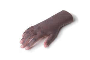 Finger Prosthetic Services | Finger Extensions New York ...