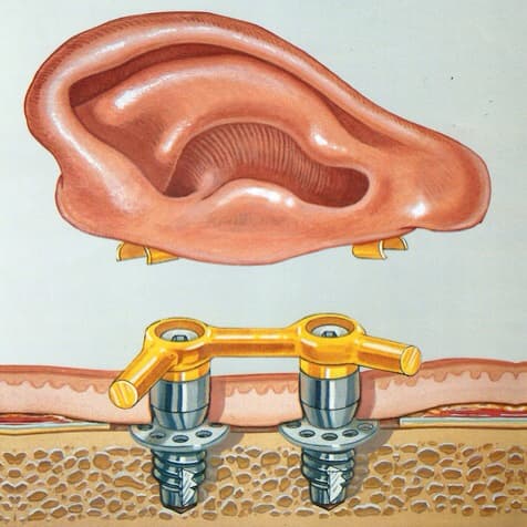 auricular implant retained prosthesis on Behance