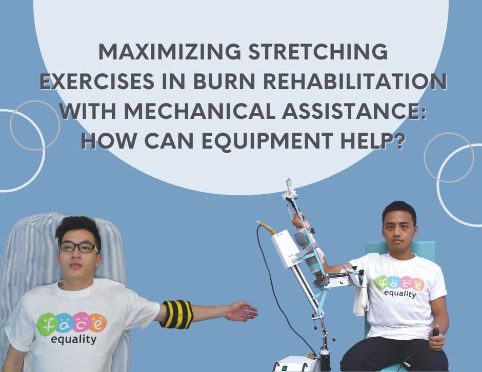 Maximizing Stretching Exercises in Burn Rehabilitation with Mechanical ...