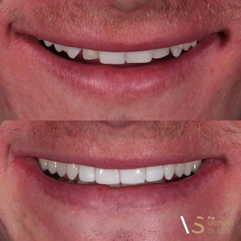 Composite Veneers Melbourne - Get Composite Resin Treatment