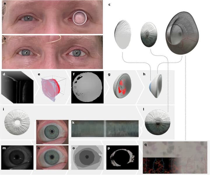 3D Printing Custom Ocular Prostheses: New Tech Insights