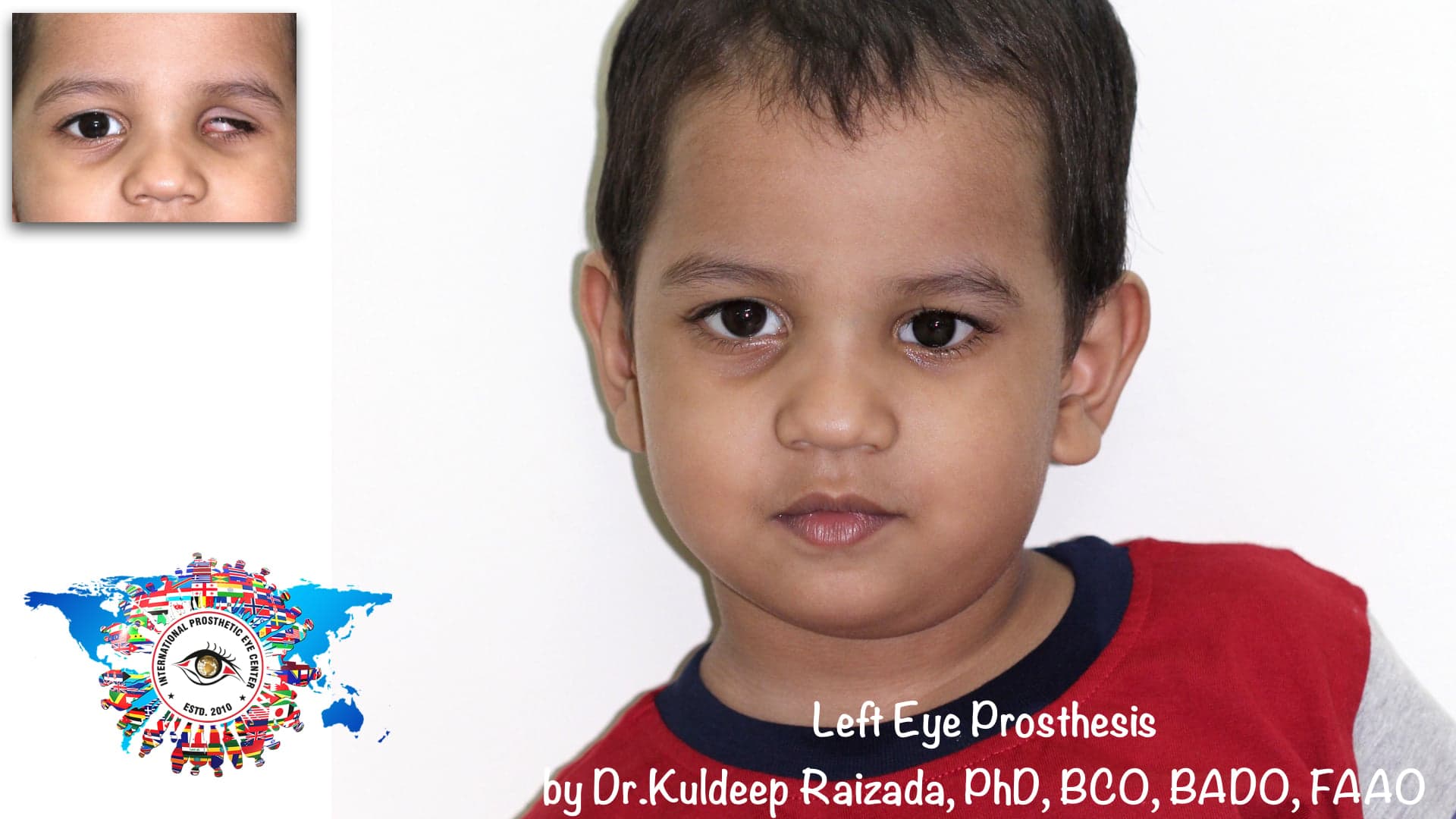 Pediatric Eye Prosthesis