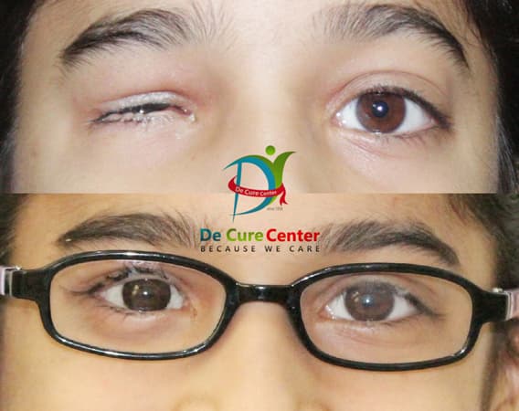 custom-made ocular prosthesis in Bangalore I Best prosthetic eye center ...